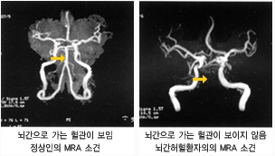 뇌간으로 가는 혈관이 보이는 정산인 소견과 혈관이 보이지 않는 뇌간허혈관환자의 MRA 소견 사진